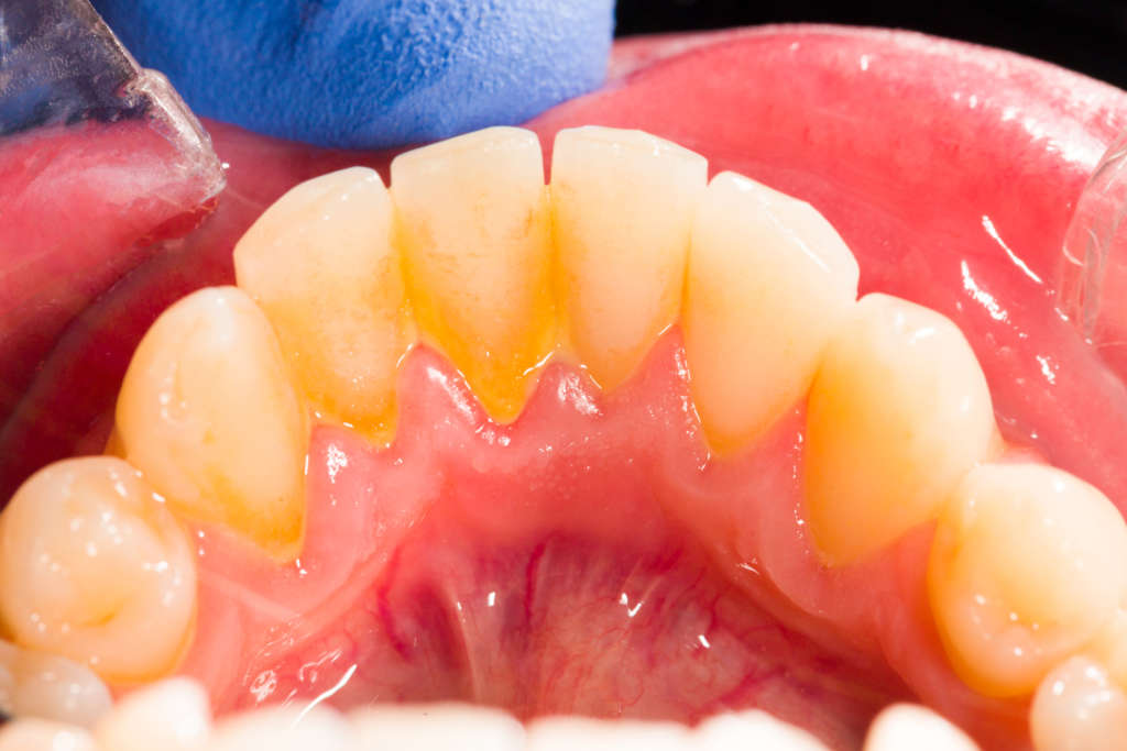 Ako odstrániť zubný kameň | MDDr. Andrea Hrubá | Zápisník zubárky