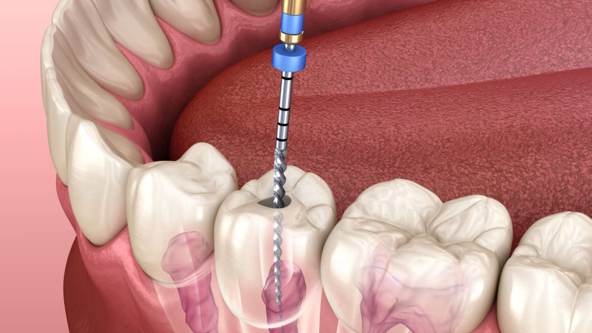 Endodoncia: Čo ma čaká pri vyberaní nervu zo zuba?
