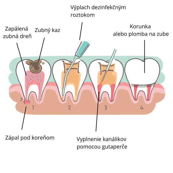 Endodoncia | Ošetrenie koreňových kanálikov | Vyberanie nervu zo zuba | MDDr. Andrea Hrubá | Zápisník zubárky